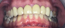 Before image of Emax Aesthetic Crowns