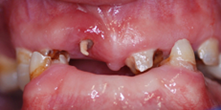 Before image of Full Upper and Lower Dentures