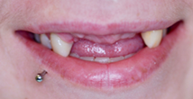 Before image of Two Implants Replacing 4Anterior Teeth