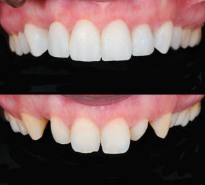 Composite Bonding before and after