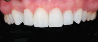 After image of Composite Bonding