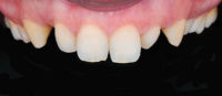 Before image of Composite Bonding